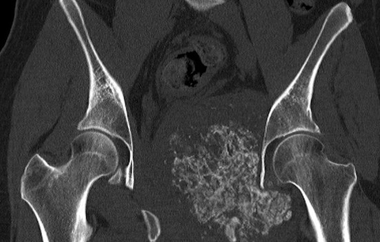 Musculoskeletal CT scans