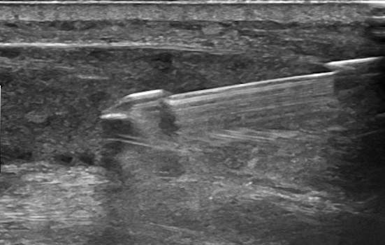 Image guided intervention