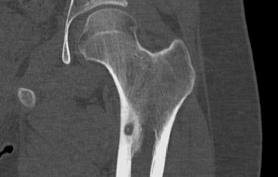 Musculoskeletal radiofrequency ablation