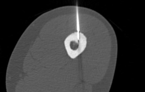 Musculoskeletal radiofrequency ablation