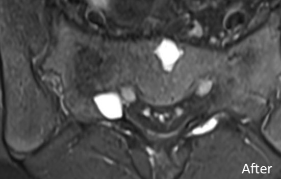 Sclerotherapy