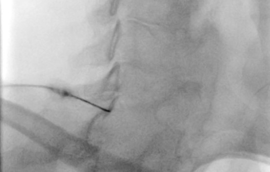 Spinal injections