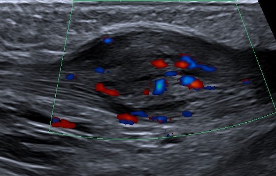 Ultrasound