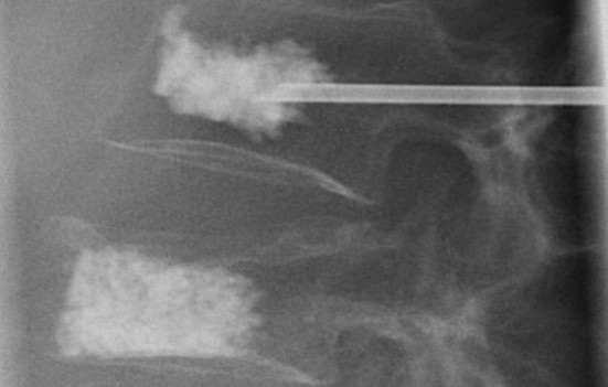 Vertebroplasty