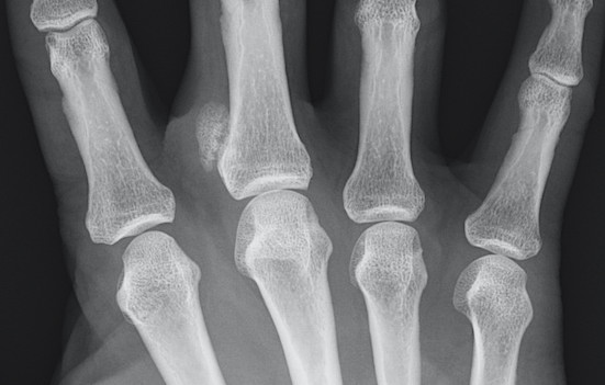 Xray