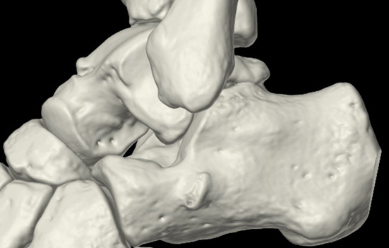 CT scan