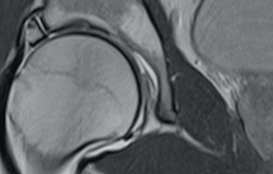 MRI