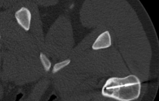 Radiofrequency ablation