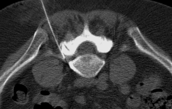 Spinal injections