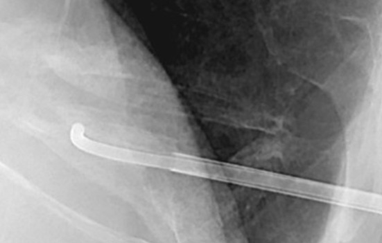 Vertebroplasty