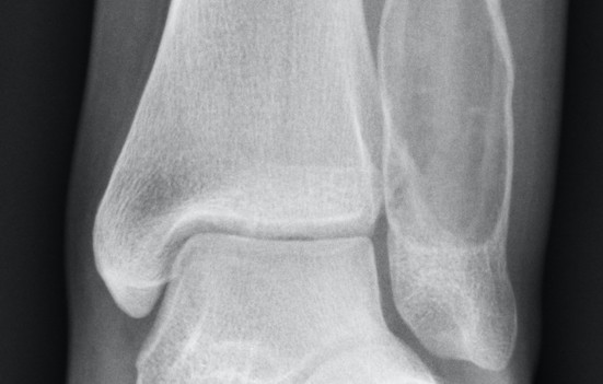 Xrays